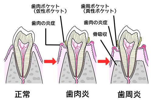 歯周病の進行